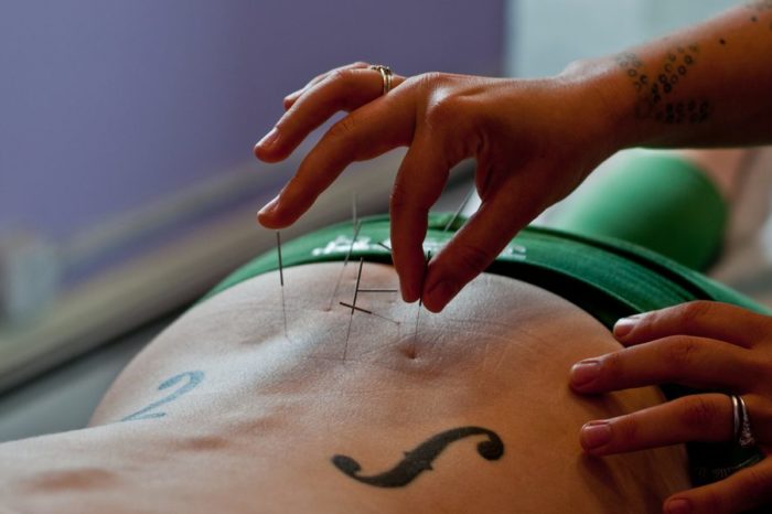 Using Acupuncture as a Remedy For Back Pain